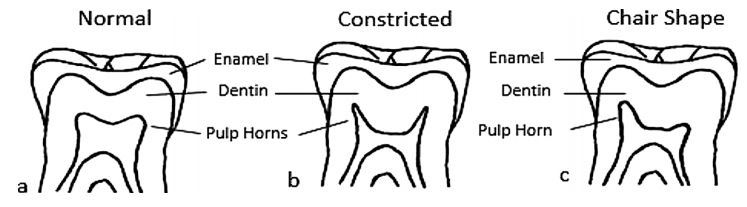 Vitamin D deficiency indicated by pulp tooth shape (X ray)– Nov 2017